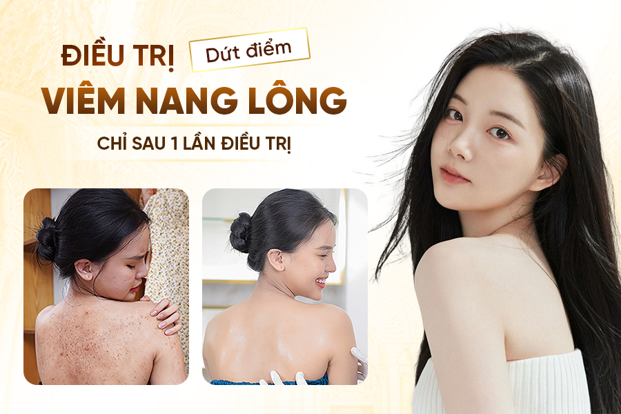 Điều Trị Viêm Nang Lông Bằng Laser Tại Oshun Biên Hòa