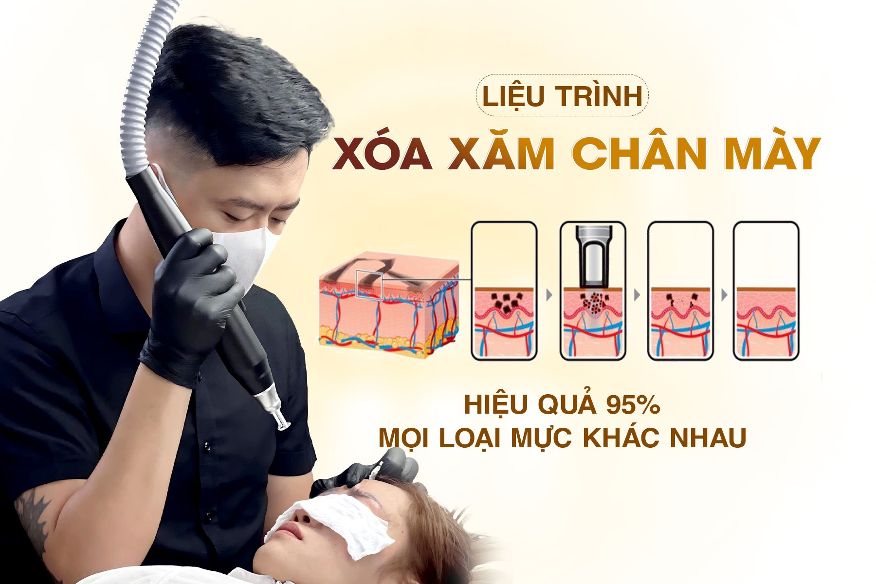 Liệu Trình Xóa Chân Mày