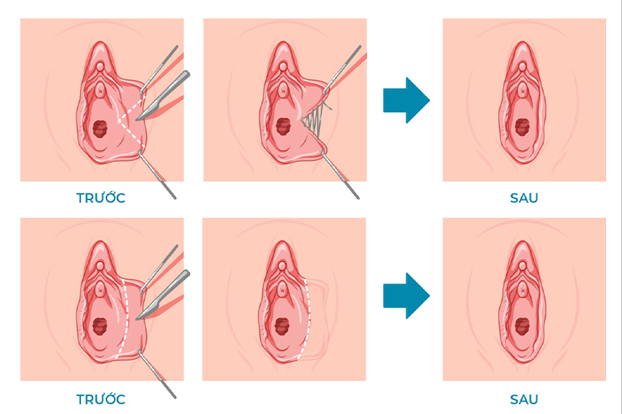 Qúa trình tiểu phẫu môi dưới vùng kín