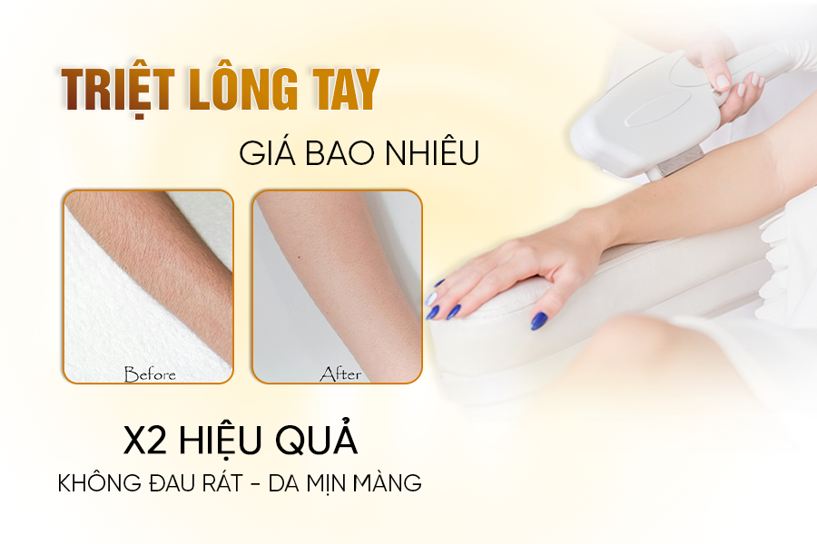 Triệt Lông Tay Vĩnh Viễn Giá Bao Nhiêu? 