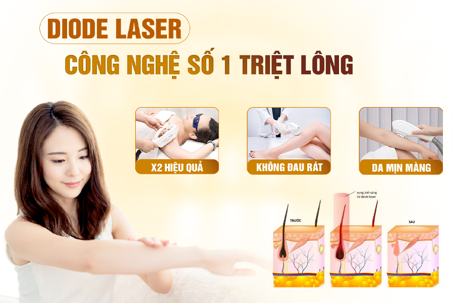 công nghệ triệt lông Laser Diode thế hệ mới