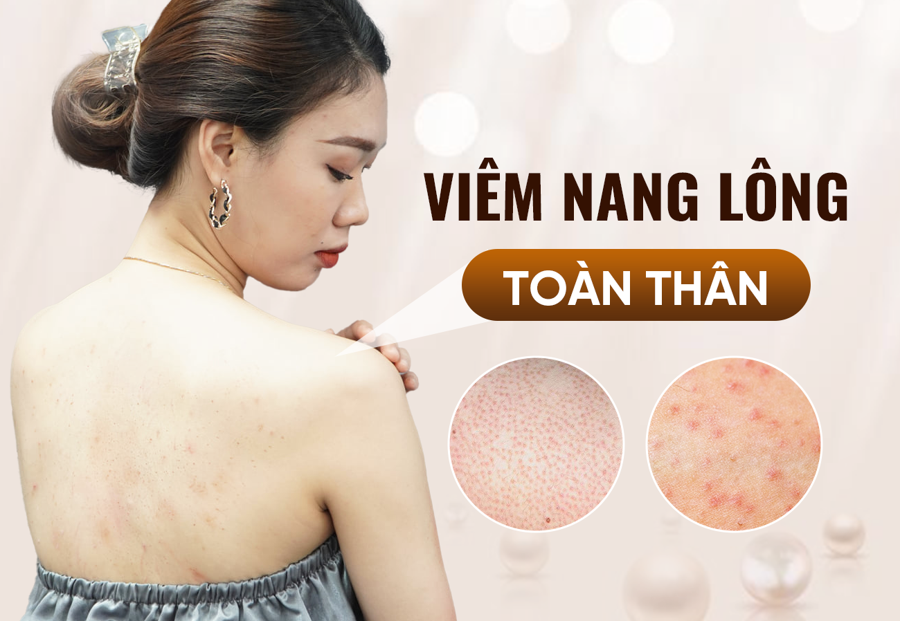 Điều Trị Viêm Nang Lông Toàn Thân Tại Oshun