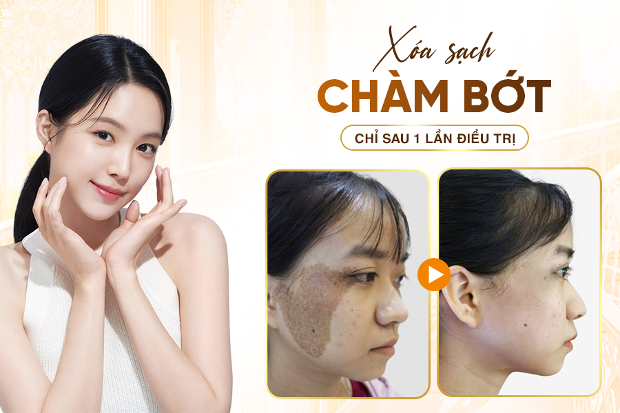 Xóa Chàm Bớt An Toàn Hiệu Quả Với Công Nghệ Laser