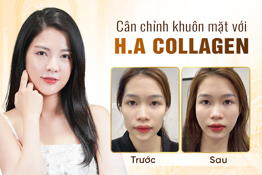 trước và sau khi thực hiện cấy Ha collagen