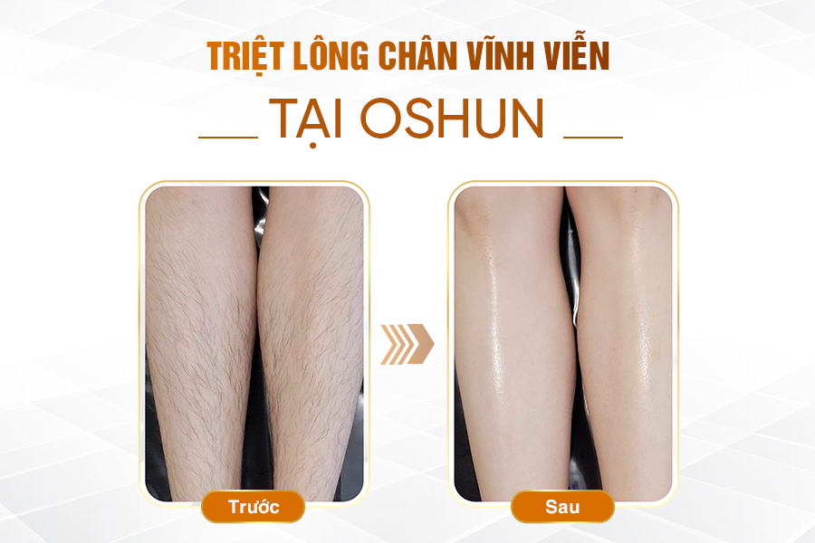 kết quả triệt lông full chân 