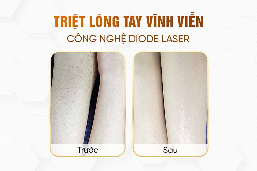 kết quả triệt lông tay