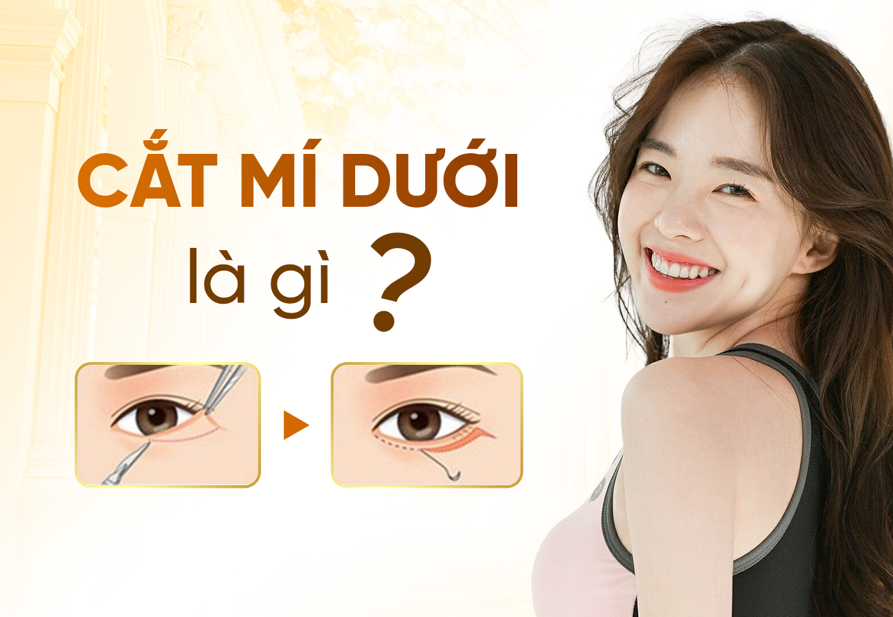 Cắt Mí Dưới Là Gì? Sau Bao Lâu Thì Lành?