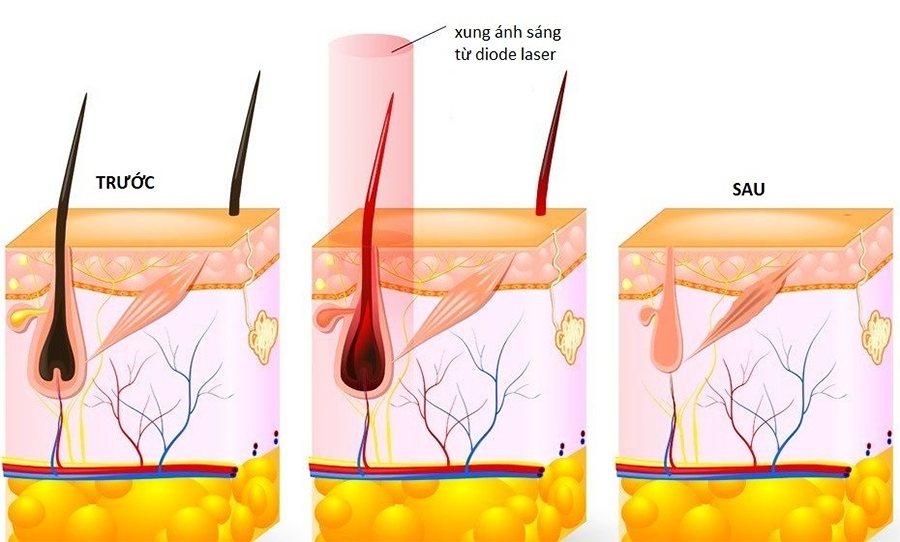 triệt lông tại biên hòa