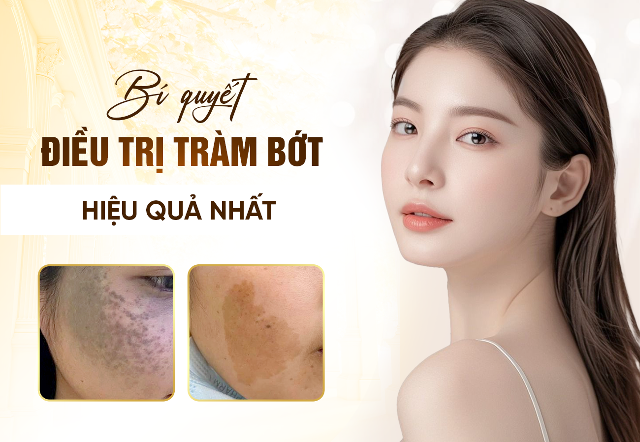 Điều Trị Chàm Bớt Bẩm Sinh Hiệu Quả 