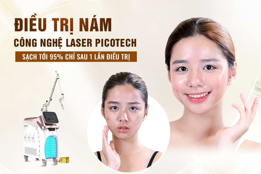 điều trị nám tận gốc