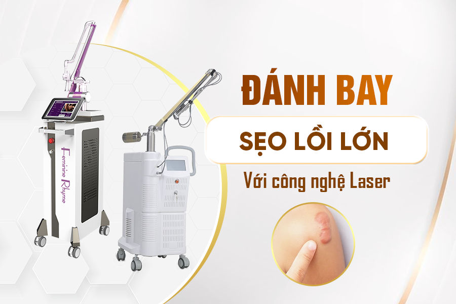 Liệu Trình Sẹo Lồi Lớn Với Công Nghệ Laser