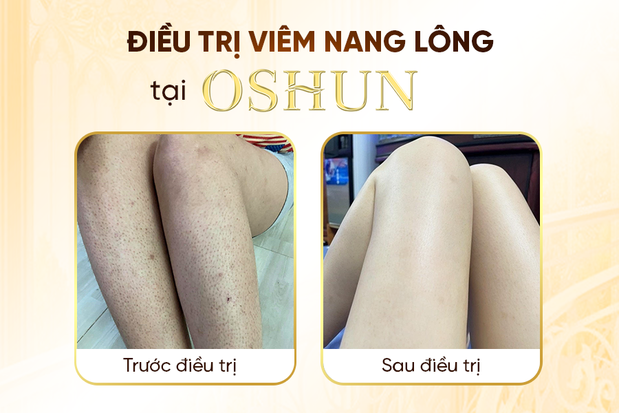 Kết quả điều trị tại thẩm mỹ viện oshun