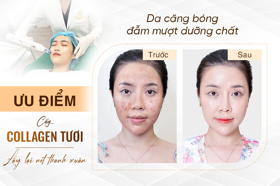 cấy ha collagen tươi