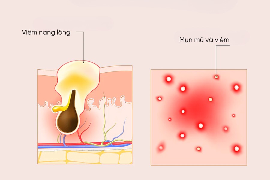 Nguyên nhân gây viêm nang lông