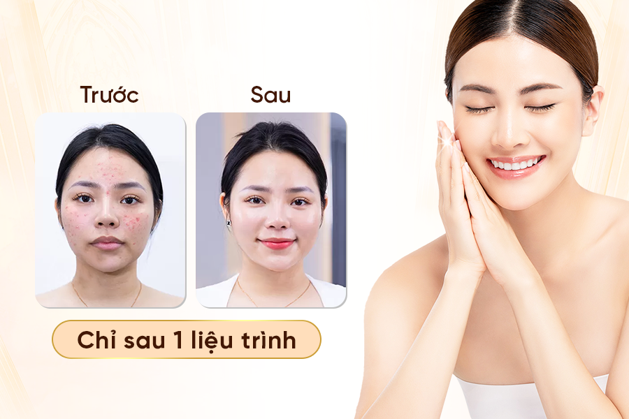 lấy nhân mụn tại biên hòa