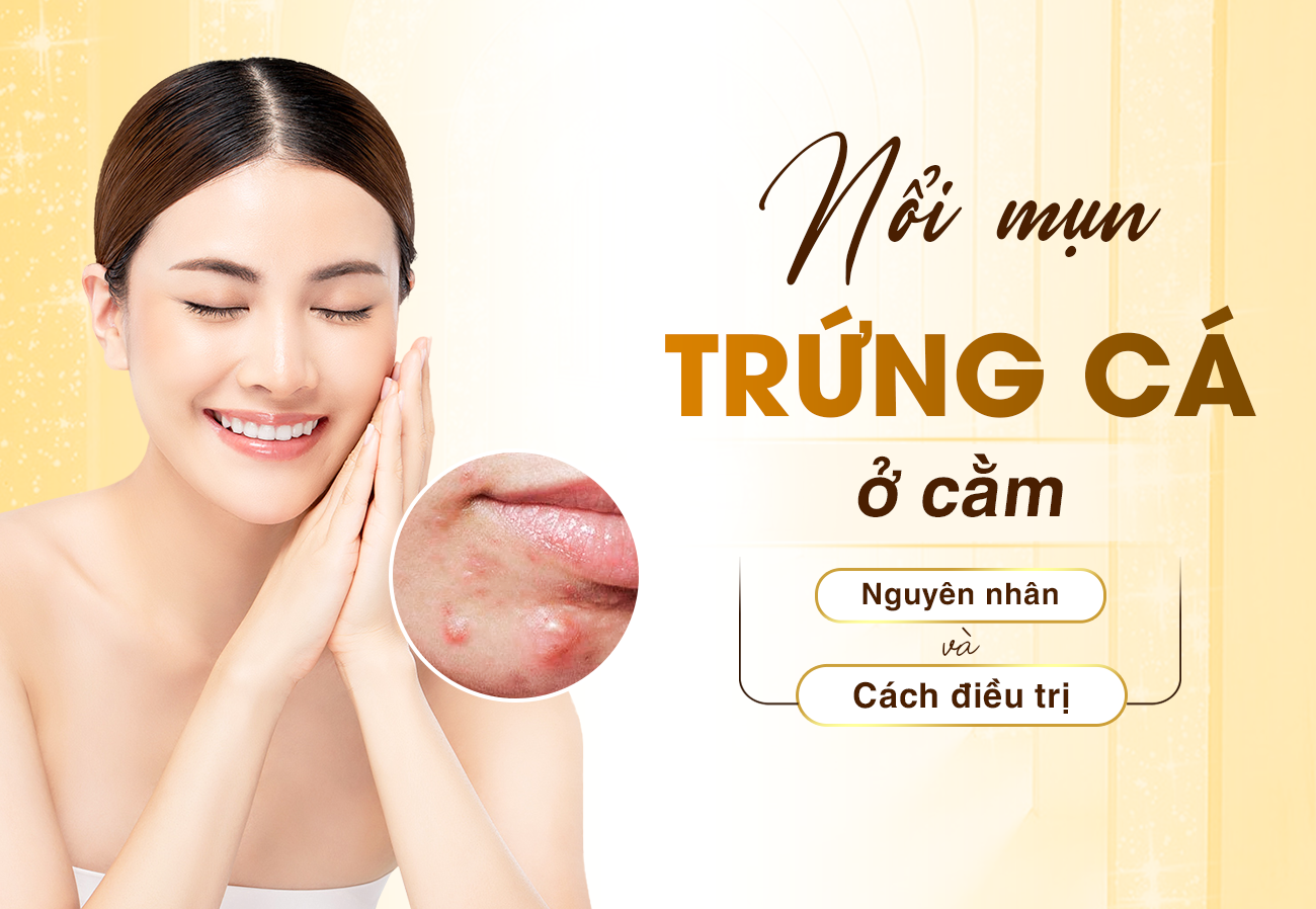 Mụn trứng cá ở cằm: Dấu hiệu, nguyên nhân và cách điều trị