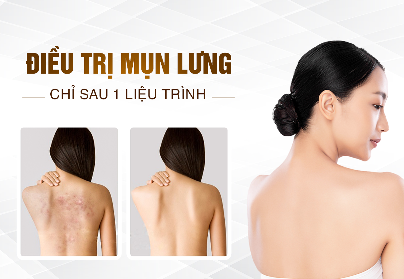 Liệu Trình Trị Mụn Lưng Biên Hòa