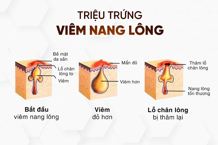 Triệu chứng viêm nang lông