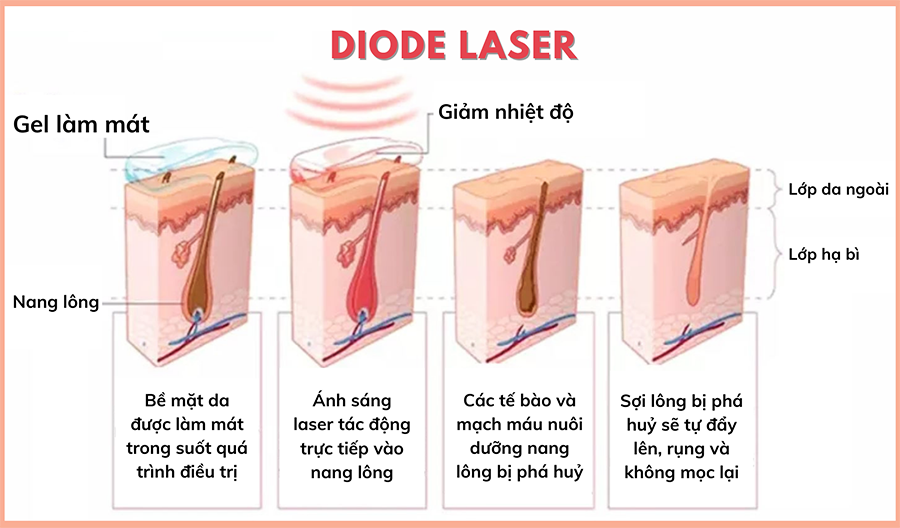 Diode Laser Triệt Lông