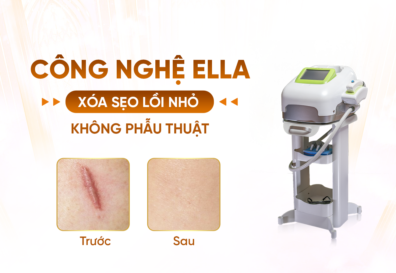 Liệu Trình Xóa Sẹo Lồi Nhỏ Với Công Nghệ Ella