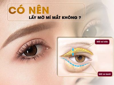 Có Nên Lấy Mỡ Mí Mắt Không? 