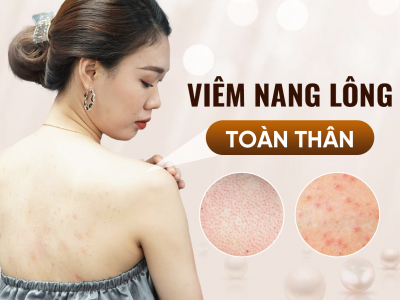 Điều Trị Viêm Nang Lông Toàn Thân Tại Oshun