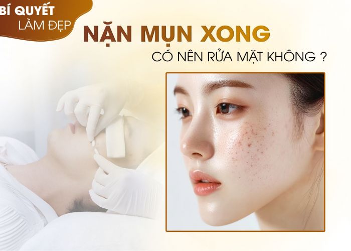 Nặn mụn xong có nên rửa mặt không? Những điều cần biết về nặn mụn