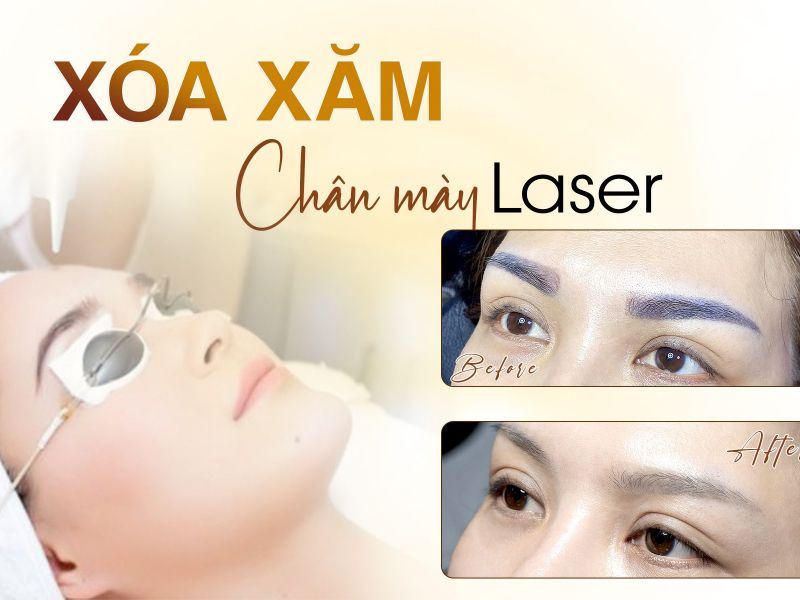 Xóa Xăm Chân Mày Bằng Laser: Đơn Giản-An Toàn-Hiệu Quả