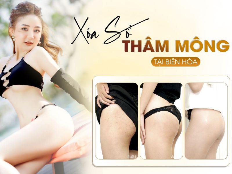 Điều Trị Thâm Mông Biên Hòa