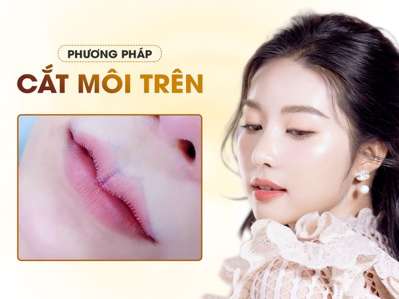 Cắt Môi Trên