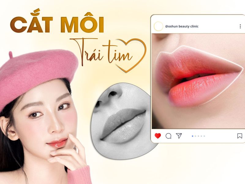 Cắt Môi Trái Tim