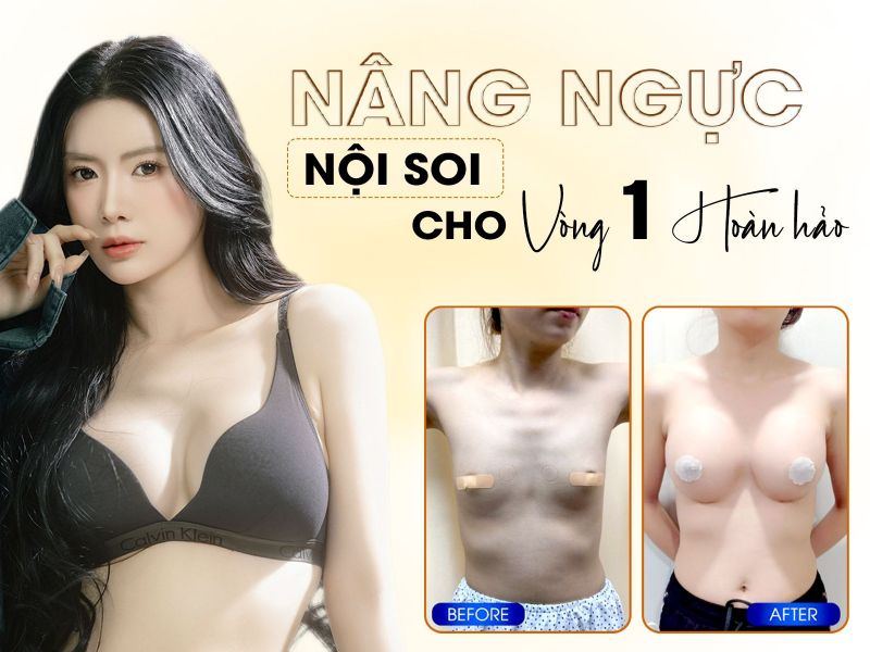 Nâng Ngực Nội Soi Cho Vòng Một Hoàn Hảo 