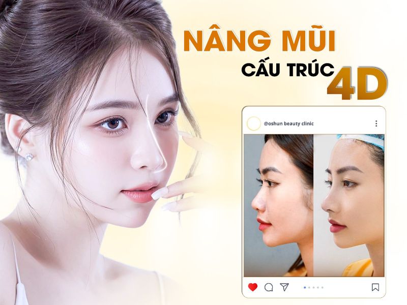 Nâng Mũi Cấu Trúc 4D-