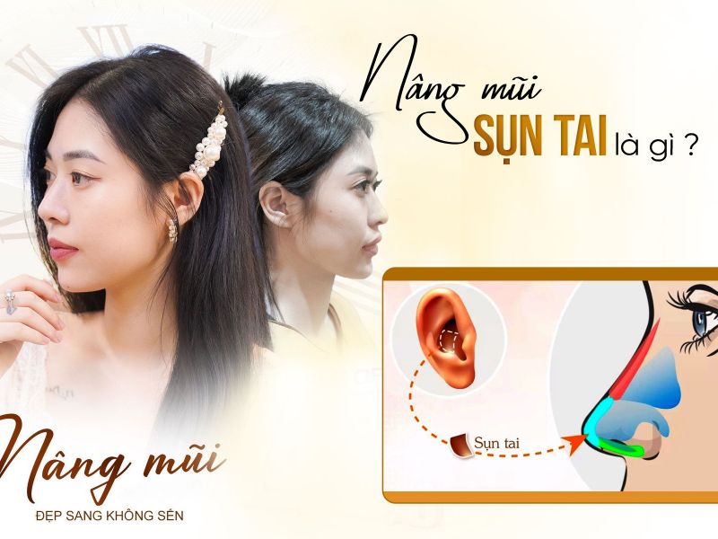 Nâng Mũi Sụn Tai Là Gì? Ai Nên Nâng Mũi Sụn Tai?