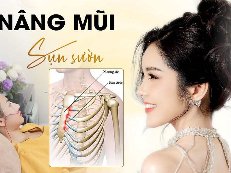 Nâng Mũi Sụn Sườn Giải Pháp Tối Ưu Để Có Mũi Đẹp Tự Nhiên