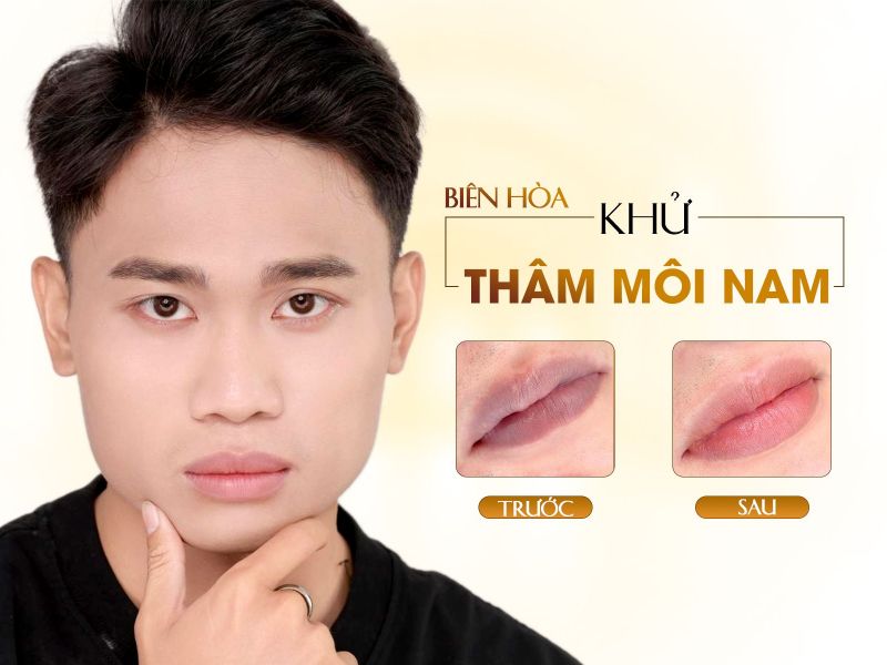 Địa Điểm Khử Thâm Môi Nam Biên Hòa