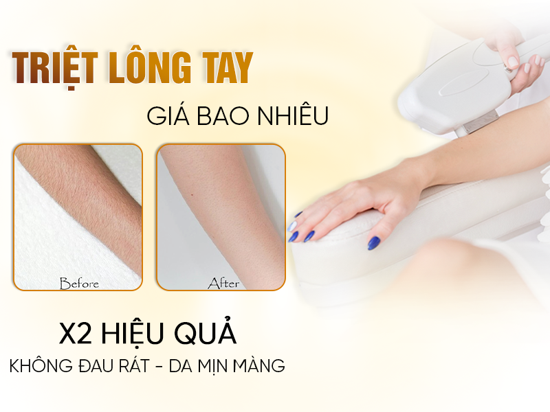 Triệt Lông Tay Vĩnh Viễn Giá Bao Nhiêu? 