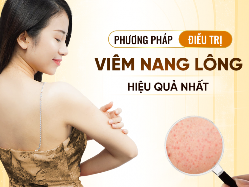 Phương Pháp Điều Trị Viêm Nang Lông Hiệu Quả Nhất 