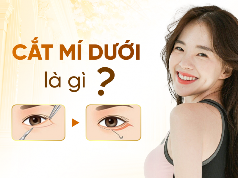 Cắt Mí Dưới Là Gì? Sau Bao Lâu Thì Lành?