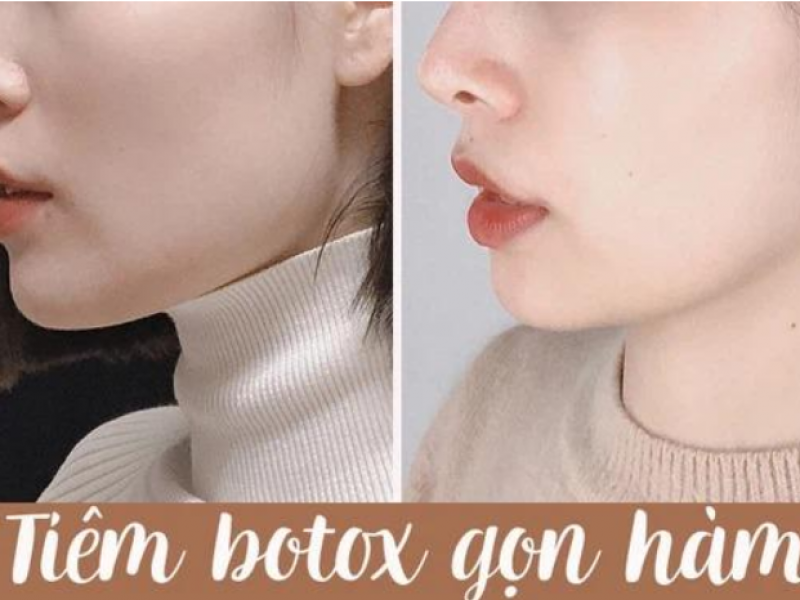 Botox Thon Gọn Hàm Hàn