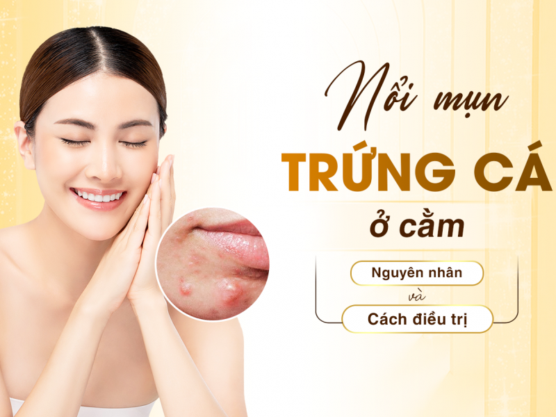 Mụn trứng cá ở cằm: Dấu hiệu, nguyên nhân và cách điều trị