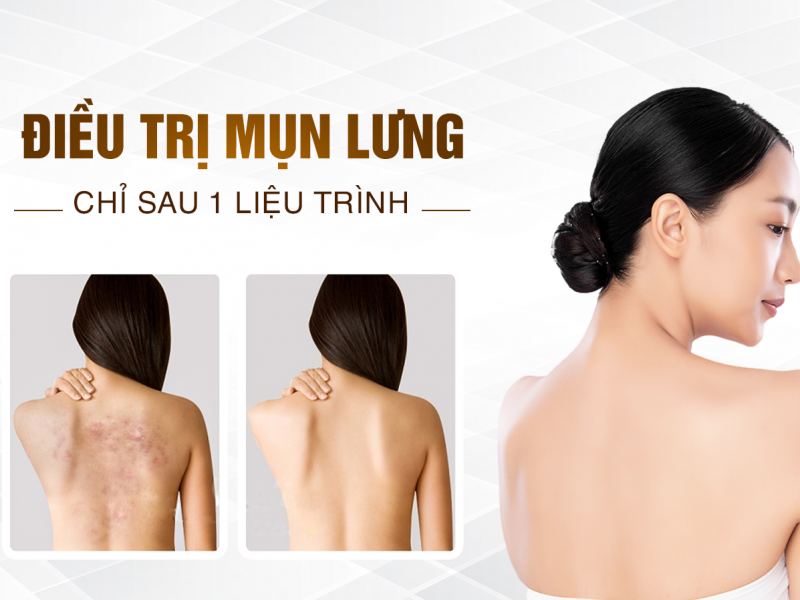 Liệu Trình Trị Mụn Lưng Biên Hòa