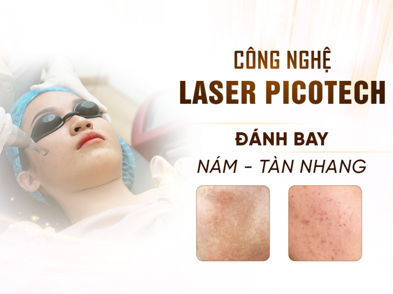 Laser Picotech Công Nghệ Điều Trị Nám Tàn Nhang