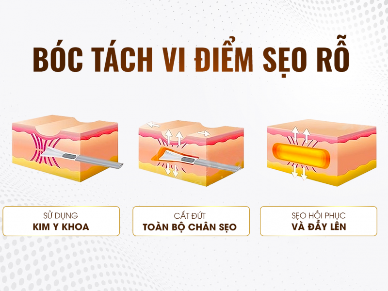  Bóc Tách Vi Điểm Sẹo Rỗ