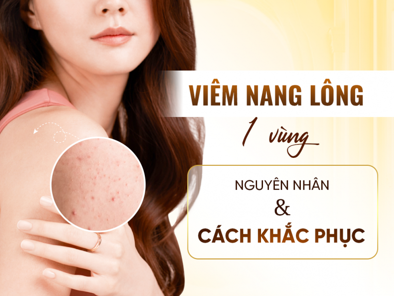 Điều Trị Viêm Nang Lông 1 Vùng: Cách Khắc Phục Nhanh Nhất