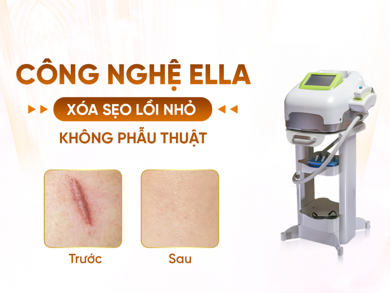 Liệu Trình Xóa Sẹo Lồi Nhỏ Với Công Nghệ Ella