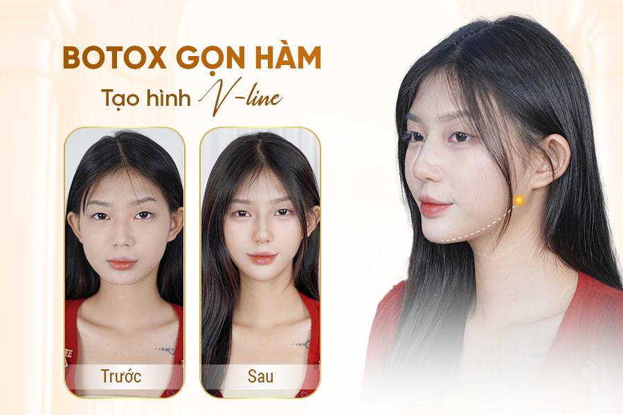 Cơ chế hoạt động của tiêm Botox