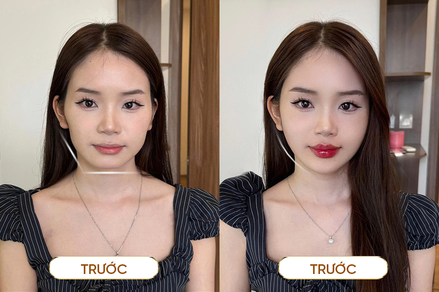 Cơ chế hoạt động của tiêm Botox